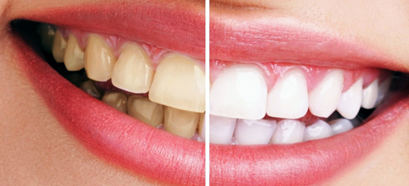 en-que-consiste-el-blanqueamiento-dental