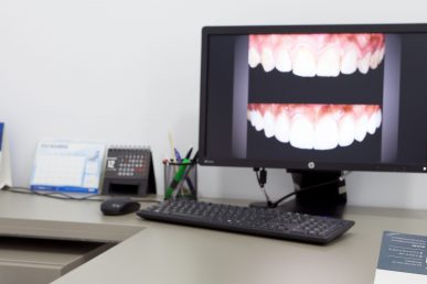 para qué aplicamos el diseño de sonrisas en la clínica dental en Barcelona Marín García