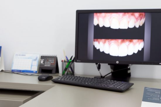 para qué aplicamos el diseño de sonrisas en la clínica dental en Barcelona Marín García