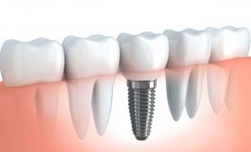 implantes de carga inmediata en Barcelona