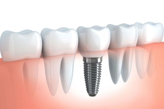 implantes de carga inmediata en Barcelona