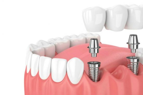 implantes de máxima calidad en Barcelona en la Clínica Dental Marín García