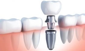 implantología oral en Barcelona