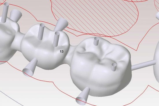 cómo mejorar tu sonrisa con la tecnología CAD /CAM en la clínica dental en Barcelona Marín García cómo mejorar tu sonrisa con la tecnología CAD /CAM en la clínica dental en Barcelona Marín García