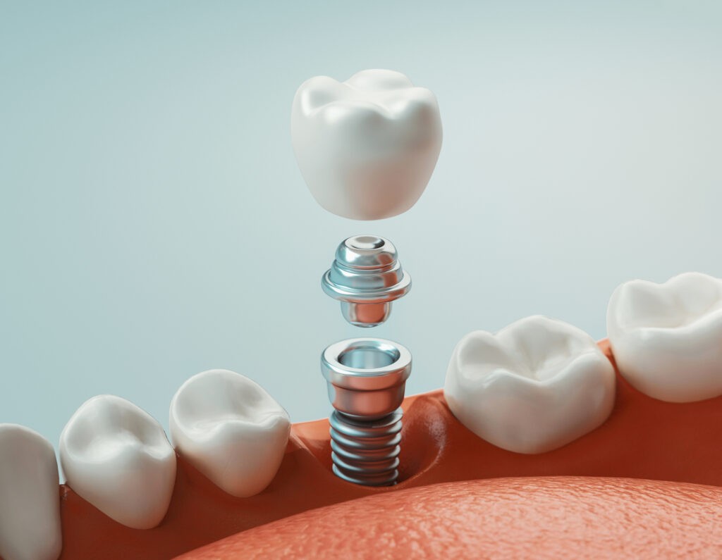 implantes dentales de carga inmediata