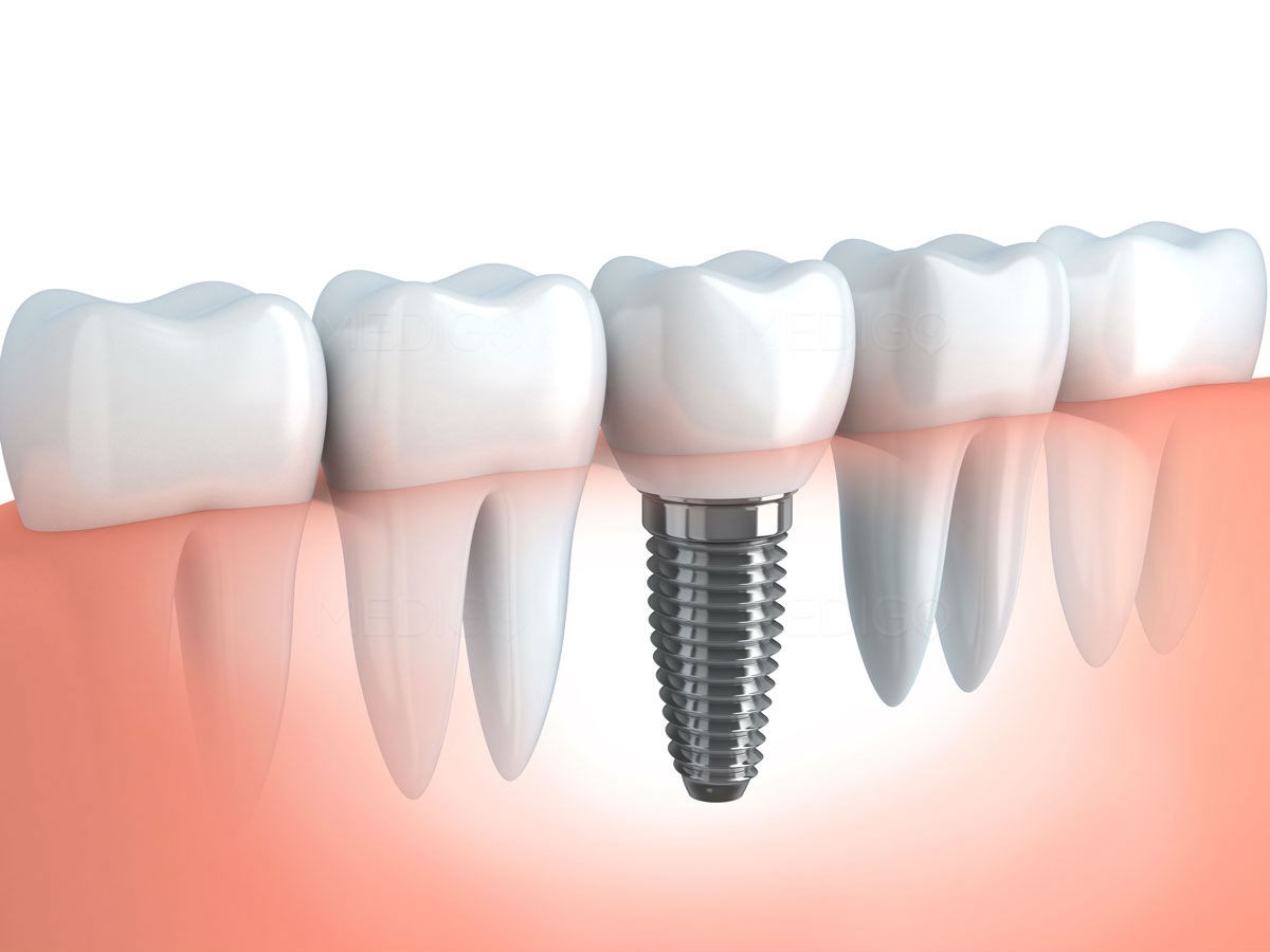 implantes de carga inmediata en Barcelona