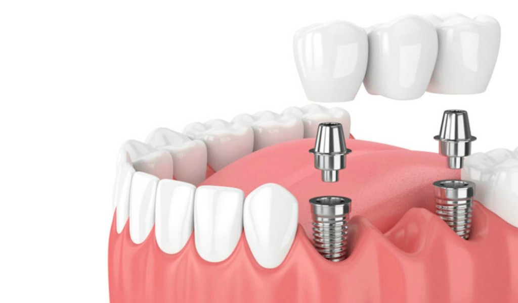 implantes de máxima calidad en Barcelona en la Clínica Dental Marín García