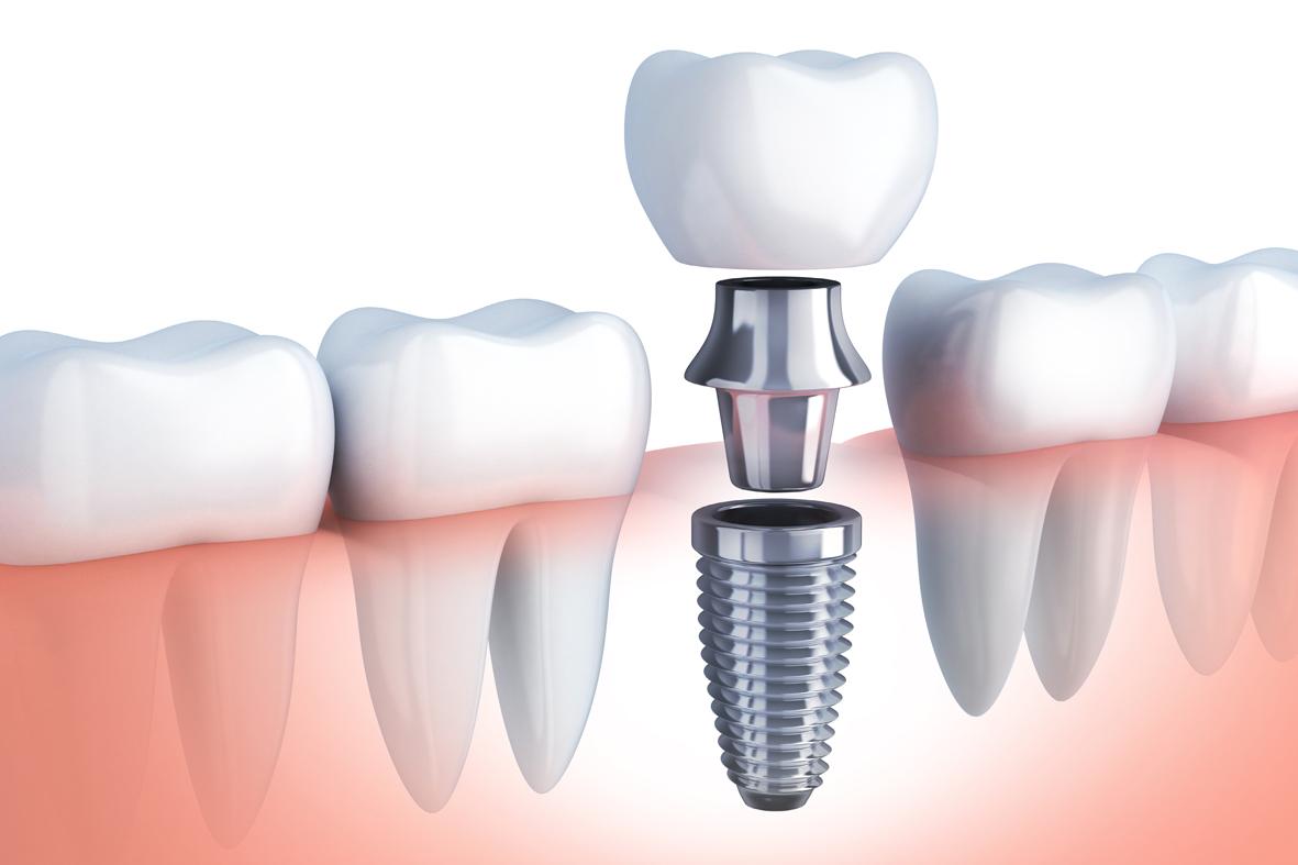 implantología oral en Barcelona