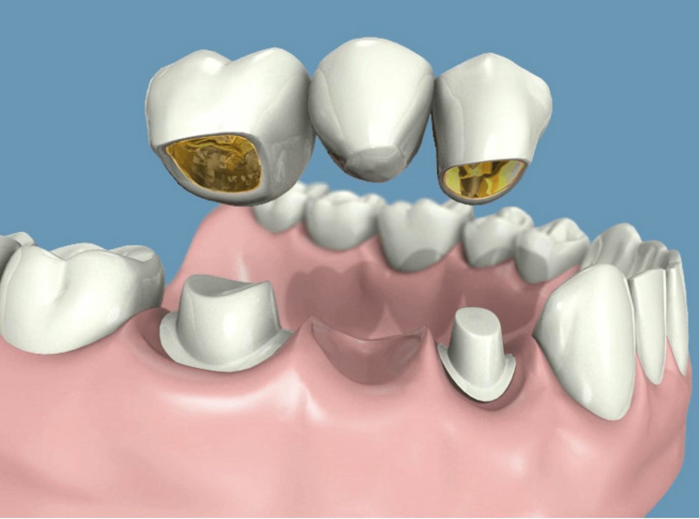 ventajas de ponerte prótesis fijas en la clínica dental en Barcelona Marín García