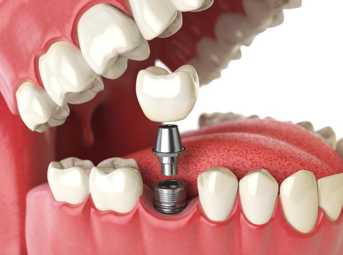 ventajas de ponerte prótesis fijas sobre implantes en la clínica dental en Barcelona Marín García